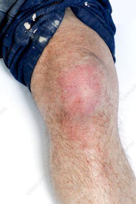 Prepatellar bursitis - Stock Image - C023/8978 - Science Photo Library