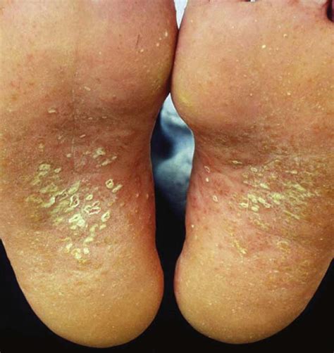 Dermatologic Signs of Systemic Disease