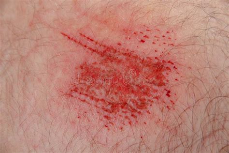 Abrasion Wound in Caucasian Skin Close Up Stock Photo - Image of caucasian, scab: 237993832