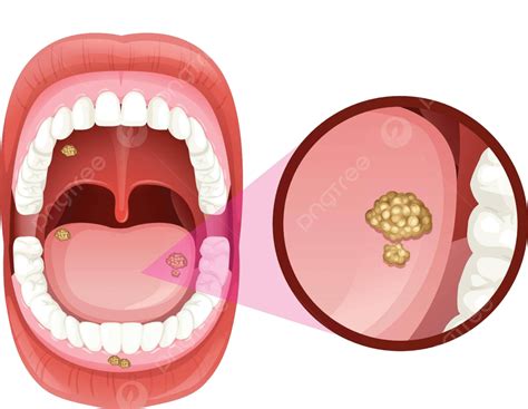 Human Mouth Anatomy Of Ulcers Stomach Medical Gastric Vector, Stomach, Medical, Gastric PNG and ...
