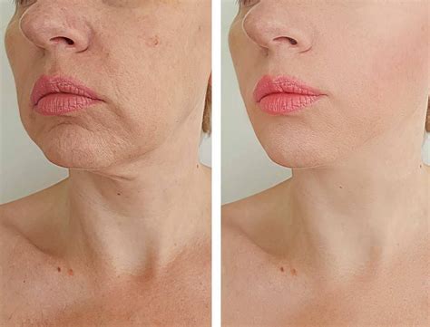 4 Hidden Benefits Of Microneedling Simply Clinics - Riset