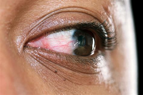 Pterygium (Surfer's Eye): Causes, Symptoms, and Treatment