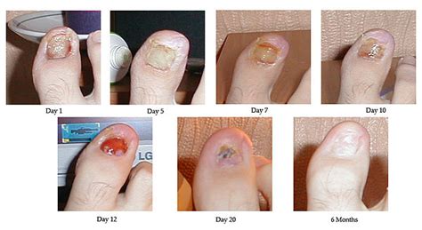Surgical treatment of ingrown toenails - Wikipedia