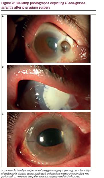 Sclera Disorders