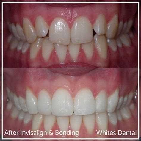 Composite Bonding Before And After | London Waterloo | Whites Dental