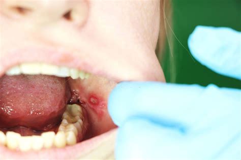 Mouth Larva or Oral Myiasis: Causes, Symptoms & Treatment