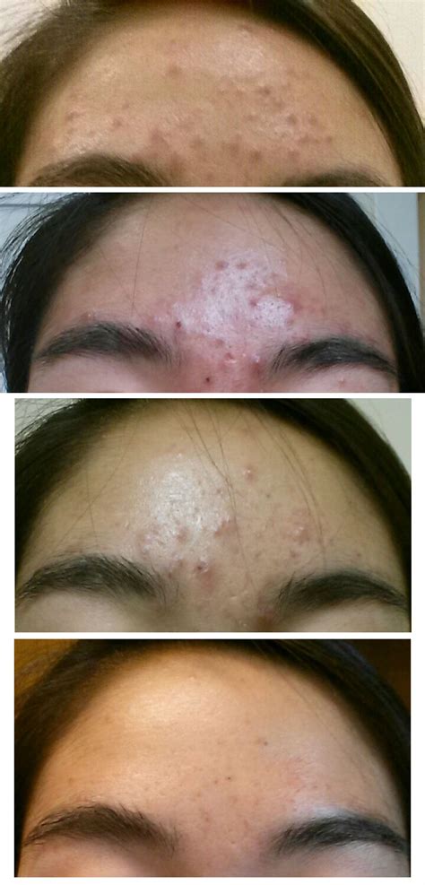 155 best Clindamycin images on Pholder | Tretinoin, Acne and Skincare Addiction