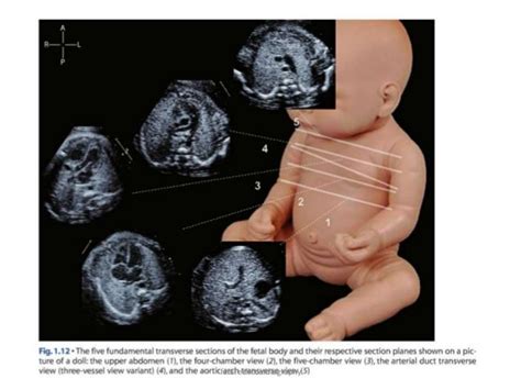 Fetal Echocardiography