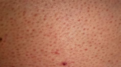 Chicken Skin (keratosis Pilaris): Causes, Treatment, And, 43% OFF