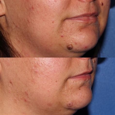 Mole Removal Scottsdale AZ | Tempe AZ - Arizona Medspa | Perfect Skin ...