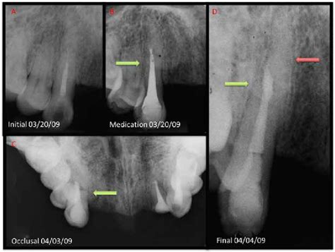 Radiographs of maxillary canine during retreatment. A - Initial... | Download Scientific Diagram