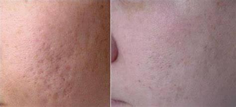 Pretty Filipinas: Effective way to improve your pitted scars: TCA cross ...