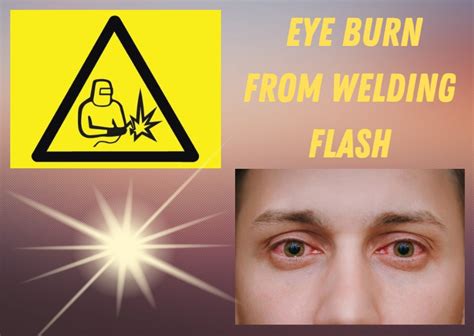 12 Best Home Remedies For Eye Burn From Welding Flash