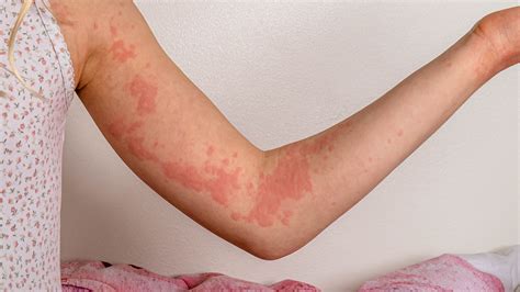 Urticaria Hives In Children Symptoms Rash Causes Trea - vrogue.co