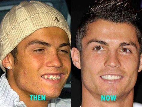 Ronaldo Teeth Before After