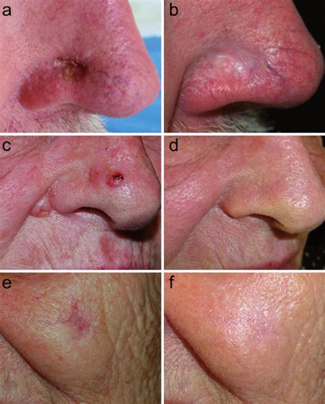 Superficial Basal Cell Carcinoma Nose