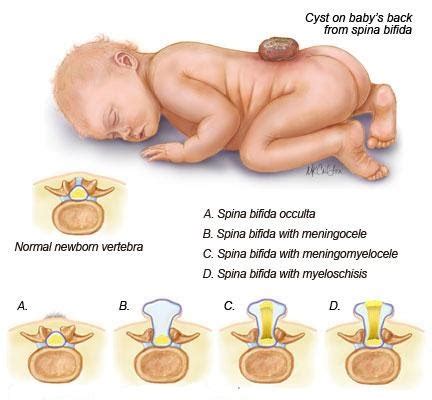 Easy Pediatrics: Spina Bifida Occulta