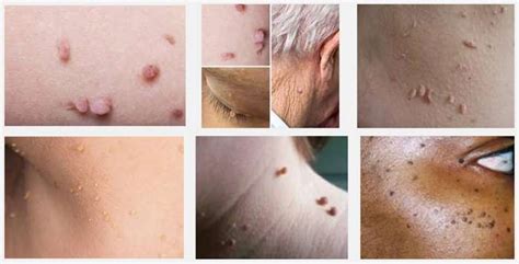 3 Tips for Managing Skin Tags as You Get a Little Older | Sixty and Me