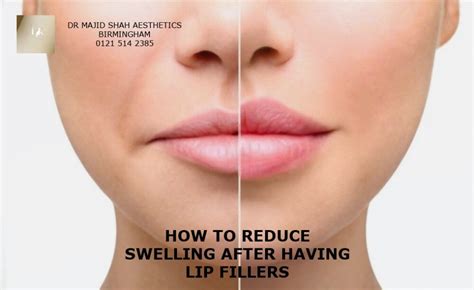 Lip Filler Swelling Stages | Lip Injections | Dr Majid Shah