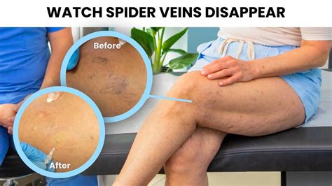 THIS Is How to Remove Spider Veins & Varicose Veins - YouTube