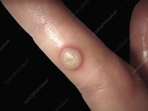 Orf skin disease - Stock Image - C052/9862 - Science Photo Library