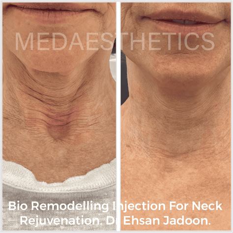 Bio-Remodelling Injections | Medaesthetics - Cosmetic Skin Clinic