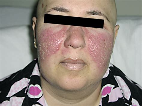 Patient with development of a rash in malar distribution 24 h after ...