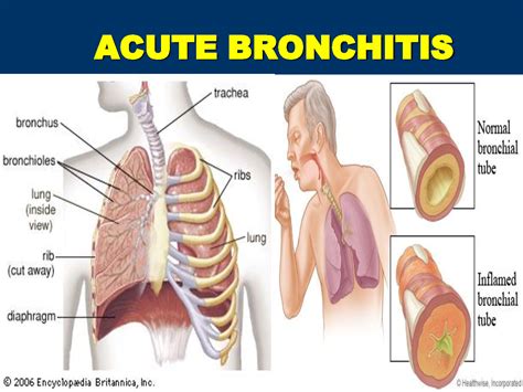 Acute Bronchitis FAQs | Signs & Symptoms and How to Treat it