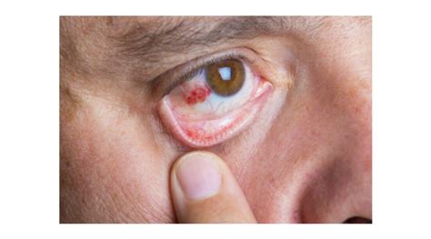 Scleritis: Causes, Symptoms and Treatment | OBN