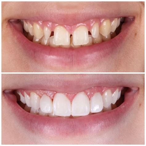 Peg laterals restored with Composite Veneers in 2023 | Composite ...