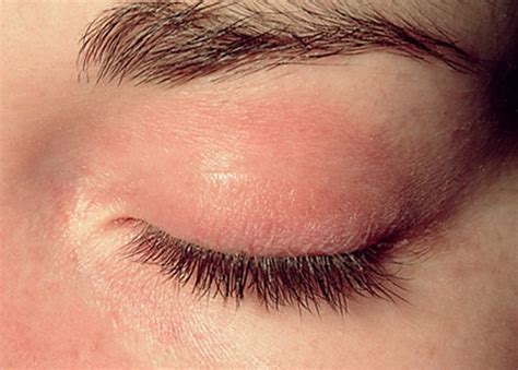 Red Rash On Eyelids | Images and Photos finder