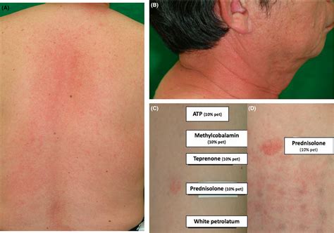 Delayed‐type cutaneous drug eruption due to oral prednisolone - Akaike ...