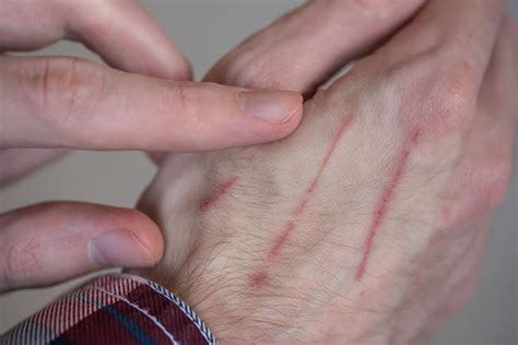 Why Do Cat Scratches Burn? 3 Reasons & Care Tips | Hepper