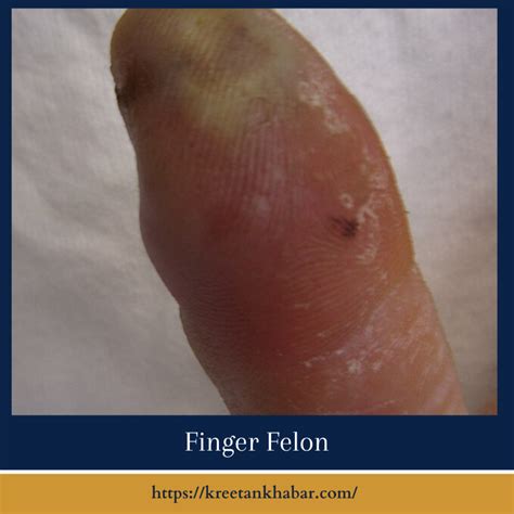 Finger Felon: Causes, Symptoms, and Treatment - Kreetan Khabar