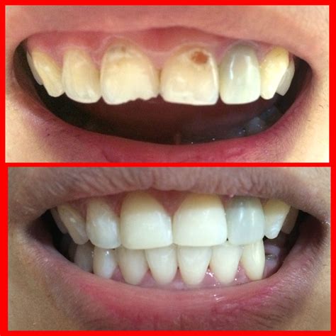 before and after tooth restoration (tooth # 11 & 12) | Dental, Dental ...