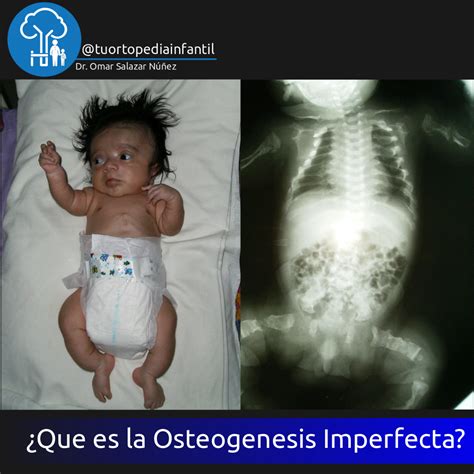 ¿Que es la Osteogenesis Imperfecta?