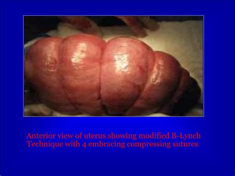 PPT - ROLE OF MODIFIED B-LYNCH SUTURE IN ATONIC PPH IN CESAREAN SECTION PowerPoint Presentation ...