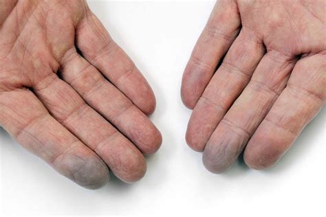 how to improve circulation in hands