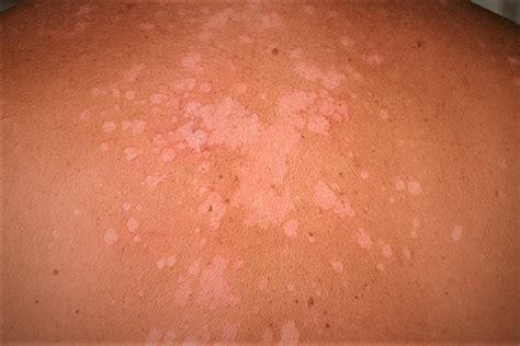 Fungal Skin Infection Of Many Colors Tinea Versicolor Pathogenesis ...