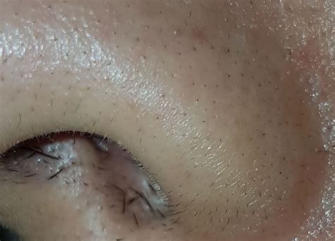 Strange Hair growth ON top of the nose and other places : r/AskDocs