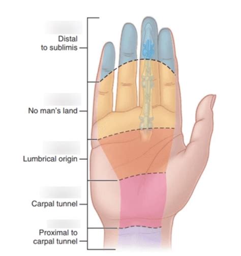 Flexor Tendon Zones Diagram | Quizlet