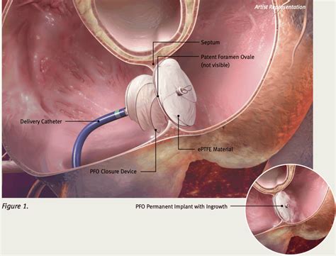 Patent Foramen Ovale (PFO) Treatment | A/Prof Peter Fahmy