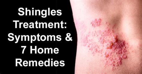 Shingles Treatment: Symptoms & 7 Home Remedies For Shingles - David Avocado Wolfe