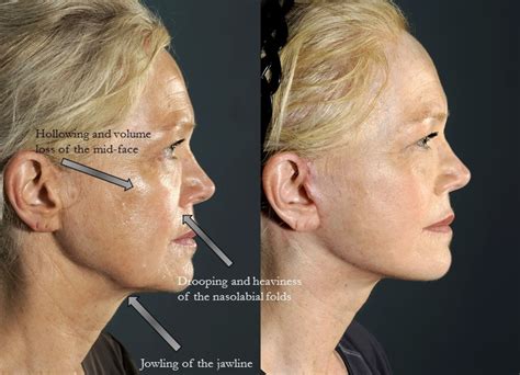 Facelift Scars: How Visible Are They? — Lara Devgan, MD, MPH, FACS