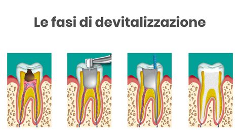 Devitalizzare un dente: cos'è, come funziona, tempi e costi