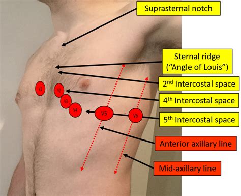 Proper Electrocardiogram (ECG/EKG) Lead Placement | ECGEDU