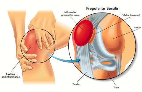 Prepatellar Knee Bursitis | Orchard Health Clinic - Osteopathy ...