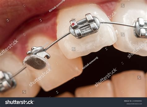 3,300 Bracket Broken Images, Stock Photos & Vectors | Shutterstock