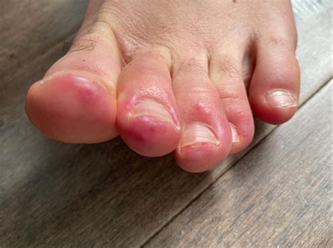 Spots On Toes And Rashes Join Weird New Symptoms Of Coronavirus - Virus ...