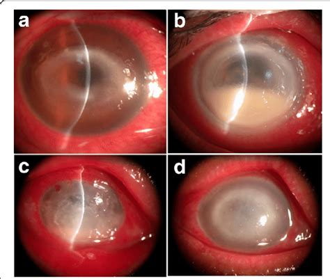 Acanthamoeba Keratitis